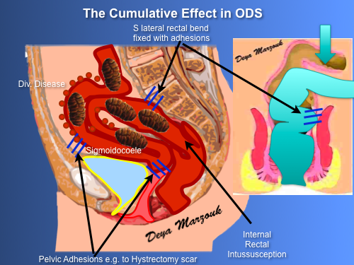 ODS Cumulative